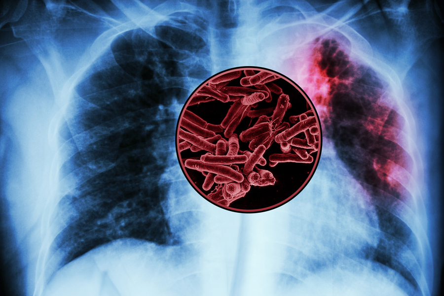 X-ray of a human chest showing the lungs, with an inset highlighting bacteria in red, indicating a lung infection such as tuberculosis. A red area marks infection in the upper right lung.